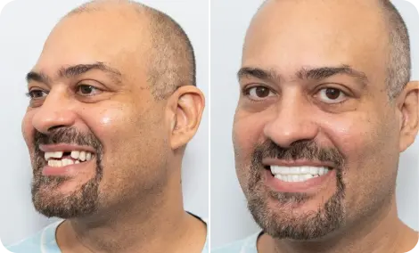 Emma from Amsterdam before and after result